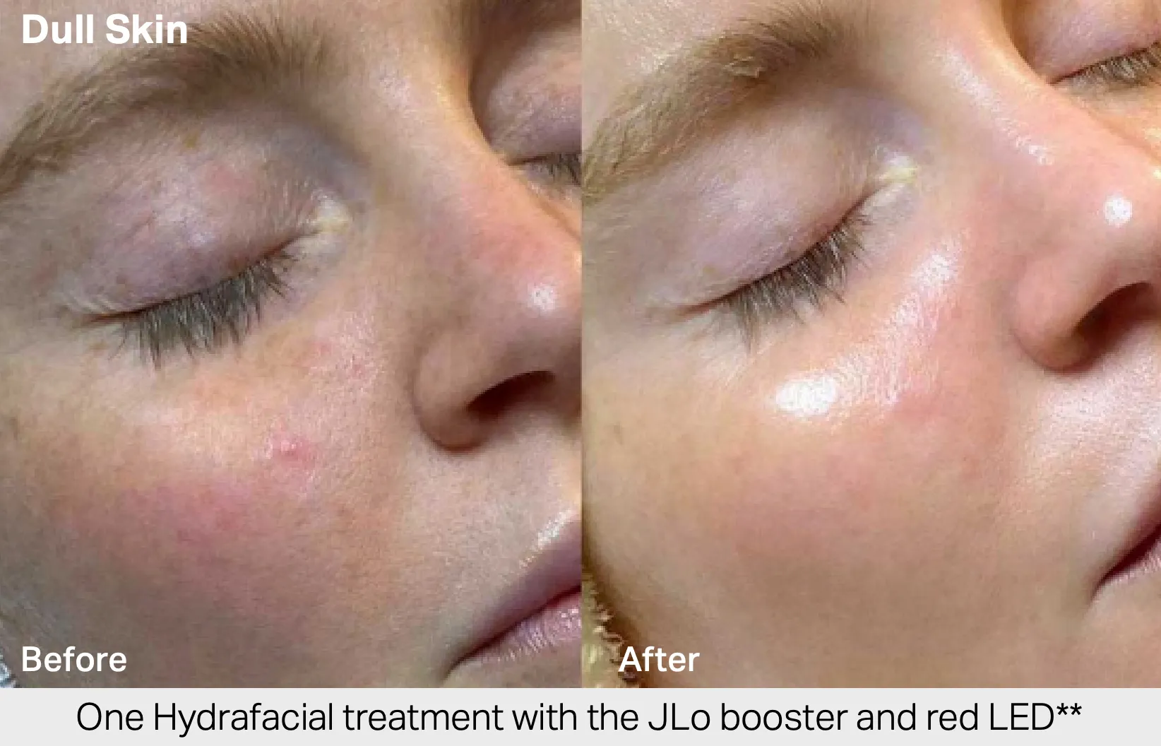HydraFacial before and after results 1