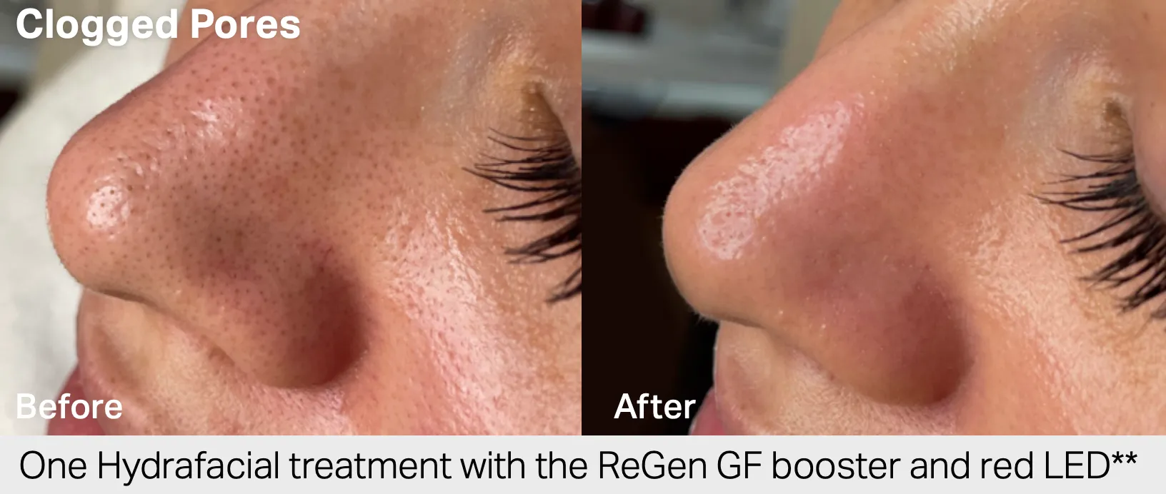 HydraFacial before and after results 2