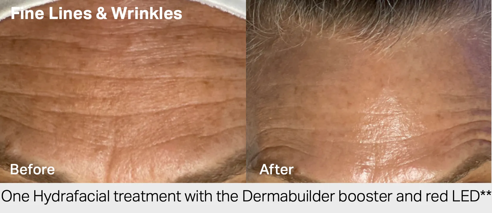 HydraFacial before and after results 3