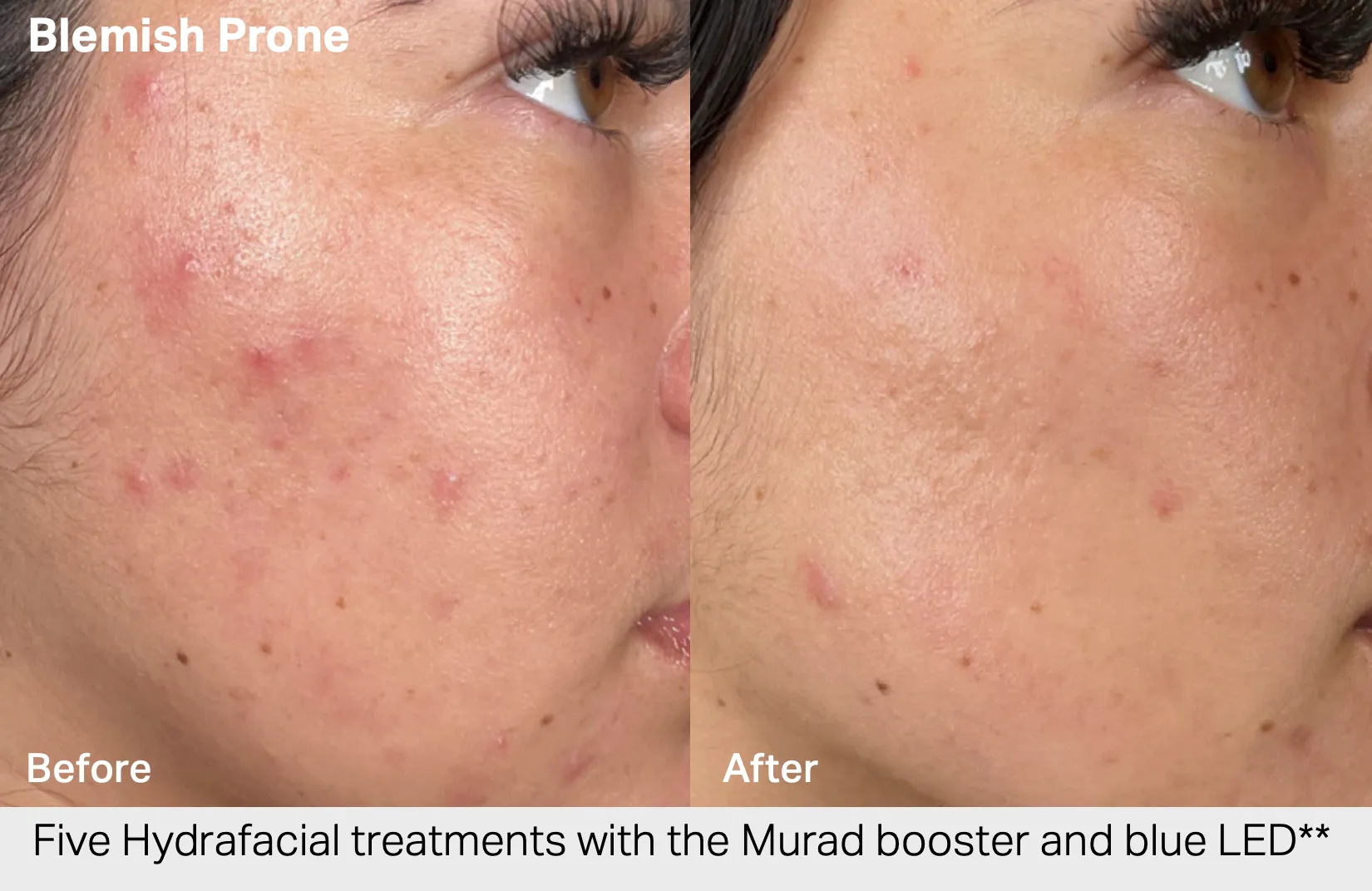 HydraFacial before and after results 4